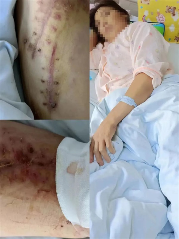 多學科聯(lián)動搶救成功！通用醫(yī)療三〇三醫(yī)院成功搶救一名耕田機絞扎致嚴重創(chuàng)傷患者(圖4)